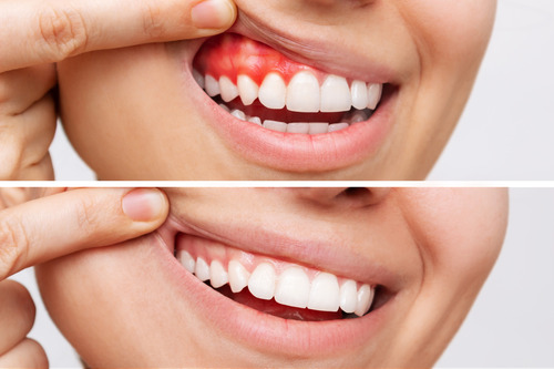 Gum disease before and after