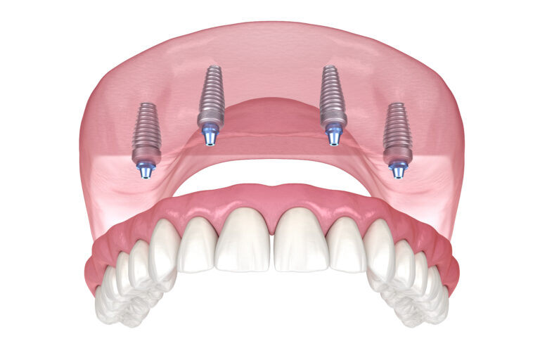 Maxillary prosthesis with gum All on 4 system supported by implants