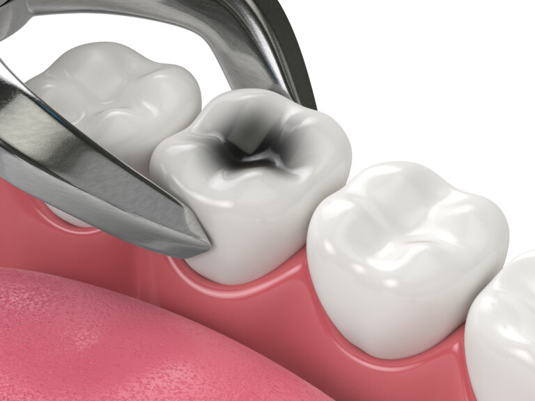 3d render of lower jaw with tooth extraction